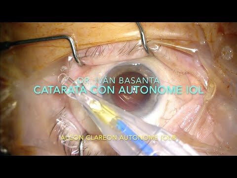 Catarata con AutonoMe IOL (Alcon Labs®)