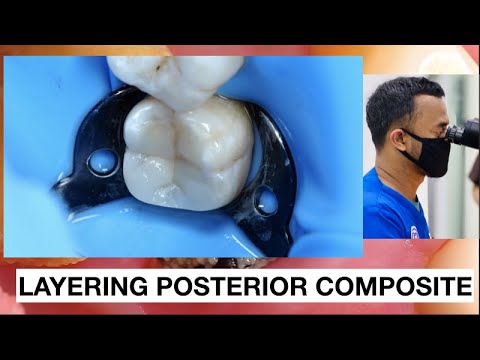 Step by Step Layering Composite Class II Distal Deep Cavity