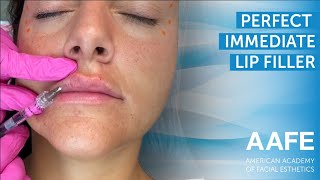 Perfect Immediate Lips - Lip Filler