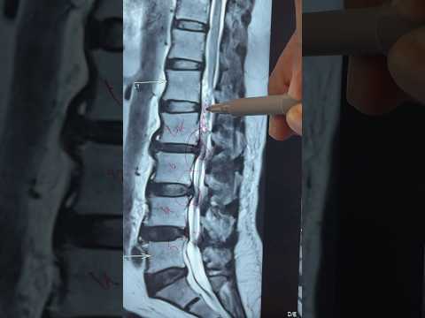 Recovery Journey After Slip Disc Herniation Surgery – From Pain to Full Mobility! | Dr. Ajay Kothari