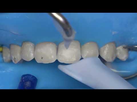 Điều trị đốm trắng