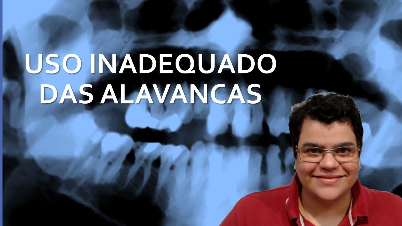 Uso inadequado das alavancas em exodontias | Dra Bianca Rosa