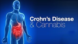 Treating Crohn’s Disease & Diabetes with Cannabis