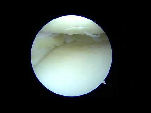 Refacerea artroscopică a ligamentelor colaterale ale articulației genunchiului