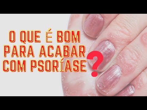 Corticosteróides fáceis em dermatite atopic Tratamentos de medicamentous em dermatite atopic