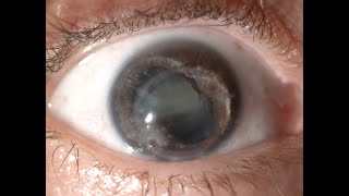 Download Lagu Challenging cataract, cornea transplant and damaged iris in keratoconus: Kanellopoulos, MD Thumbnail
