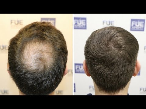 download lagu mp3 mp4 Crown Hair Transplant Timeline, download lagu Crown Hair Transplant Timeline gratis, unduh video klip Crown Hair Transplant Timeline