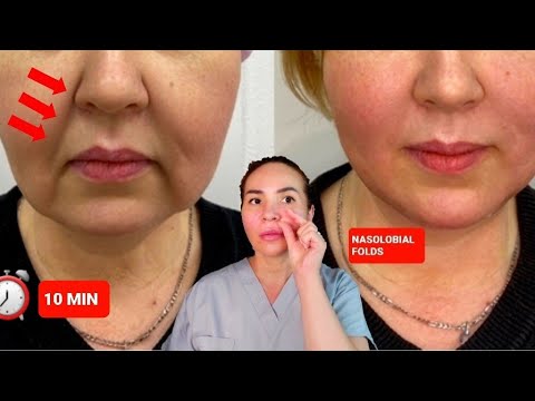 EFFECTIVE TECHNIQUES FOR THE NASOLABIAL FOLDS | NO WORDS