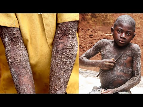 12-Year-Old Boy Is Turning Into Stone | BORN DIFFERENT