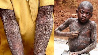 12-Year-Old Boy Is Turning Into Stone | BORN DIFFERENT