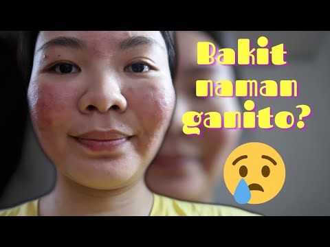 CO2 FRACTIONAL LASER UPDATE (1 - 3 sessions)  |  MK Masaudling TV