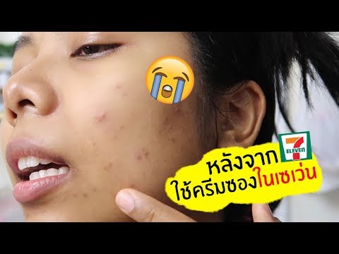 ร้องไห้กลากในมนุษย์ การผ่าตัดรักษาโรคสะเก็ดเงิน