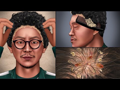ASMR 'Squid Game' Yongsik's Cool Removal of Head LiceㅣTreatment for Irritable Scalp
