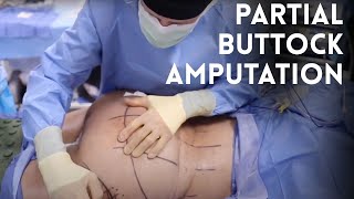 Silicone Injections Removed from the Buttock with the Open Technique by Dr. Katzen