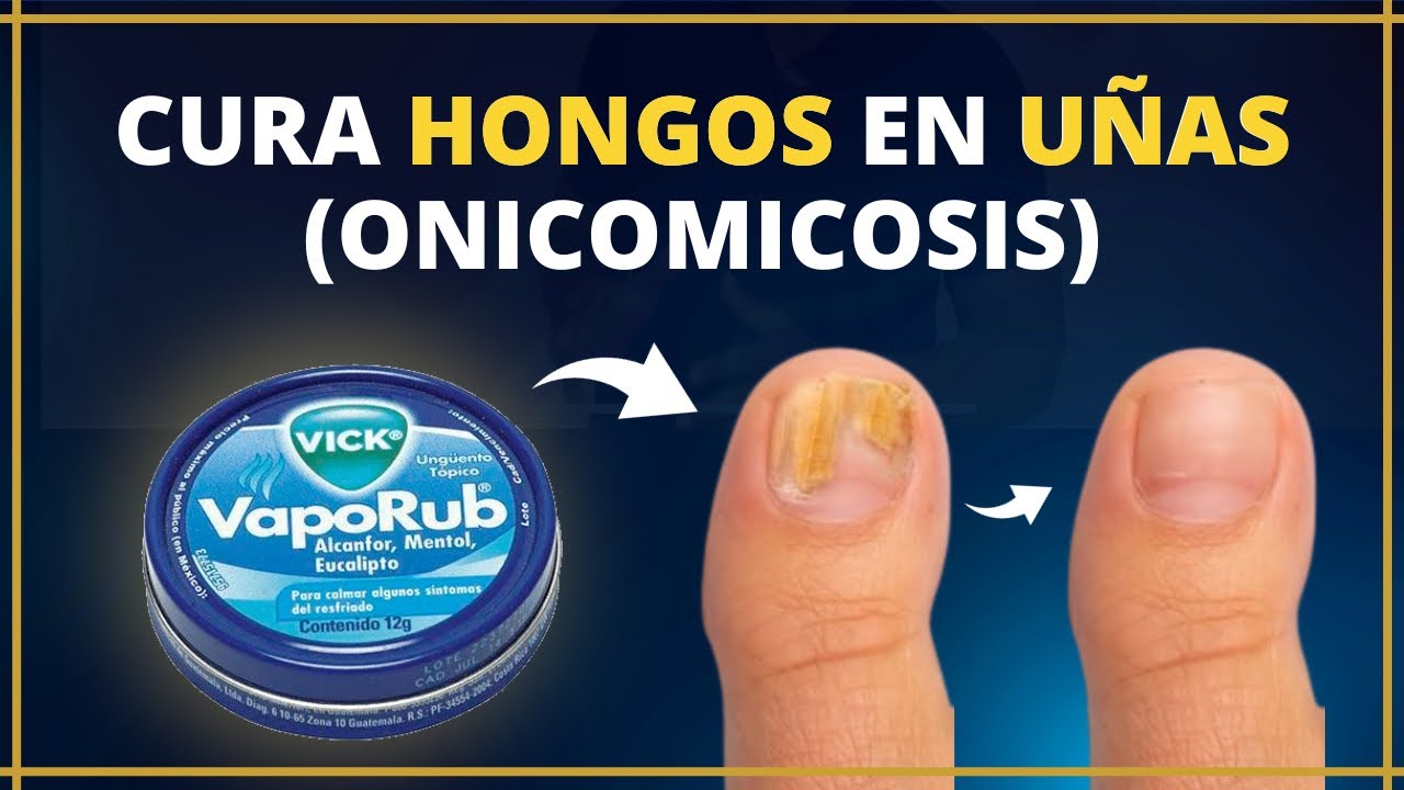 CURA HONGOS en UÑAS con Vicks VapoRub | Evidencia Científica