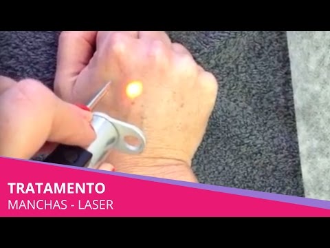 Togliere pigmentary nota Perm Se ci sono posti di pigmentary