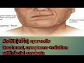 Bams Ayurved Pathology Paralysis Rognidan