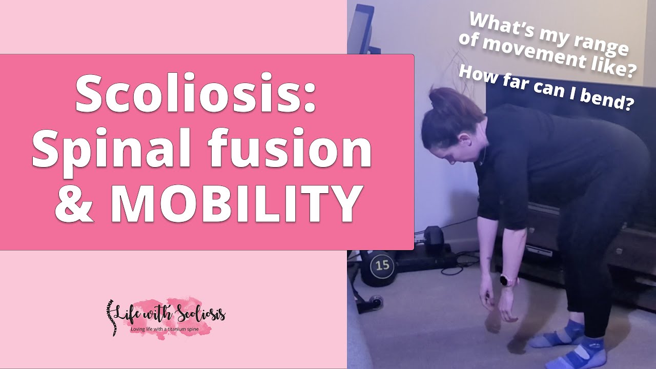 Scoliosis: Spinal Fusion and Mobility | Life with Scoliosis