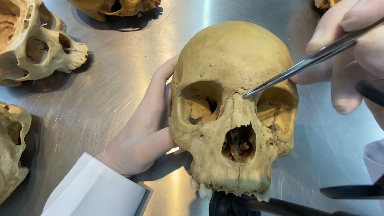 Articulações do Crânio - Suturas, Gonfoses, Sincondrose e Sinoviais.