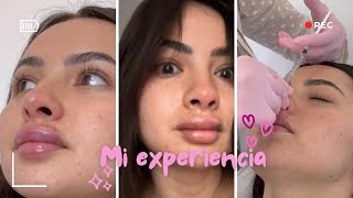 Me realice la RINOLIPS 👃👄