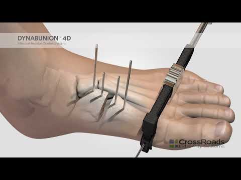 dynaBunion™ 4D Minimal-Incision Lapidus System - Surgical Animation