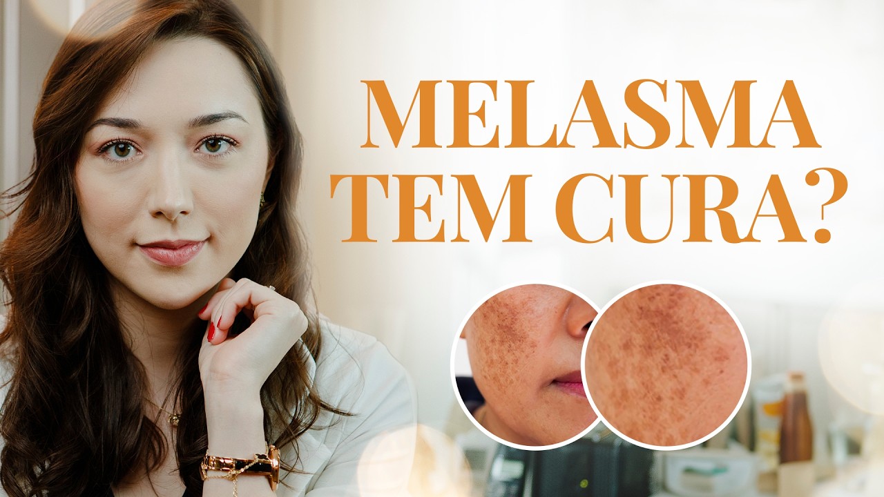 Será que MELASMA tem CURA? I Entenda como cuidar do seu melasma