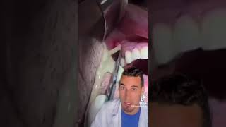 🛑 INFECCIÓN dental en una MUELA - Cómo sacar PUS de la encía #shorts