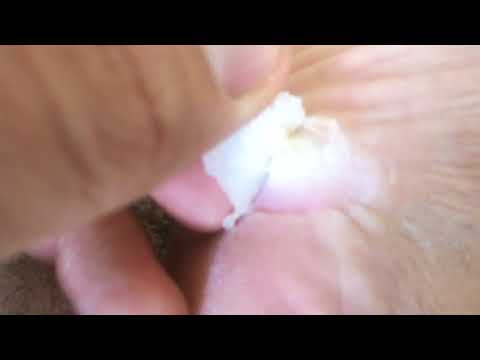 How to remove papillomas and warts