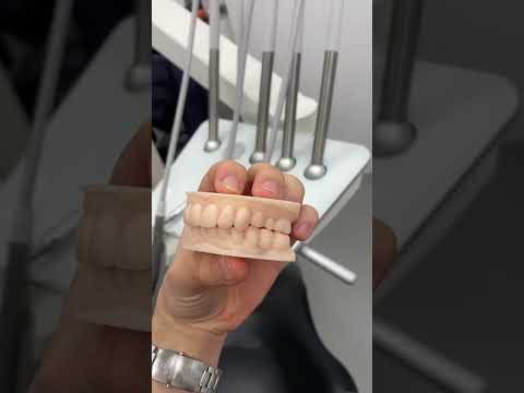 Cas clinique - Composite injecté – Esthétique