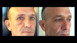 ד"ר אבישי וינברגר - ניתוח אף והרמת עפעפיים