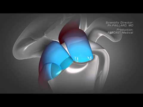 Shoulder Arthroscopy - Rotator Cuff Repair