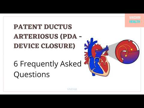 Patent ductus arteriosus-6 Frequently Asked Questions