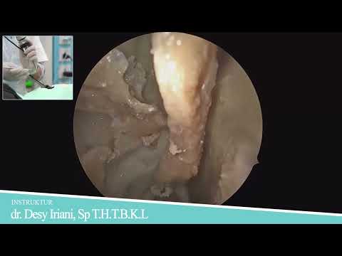Turbinoplasty and Sphenopalatine Artery Ligation — dr. Desy Iriani, Sp.T.H.T.B.K.L.