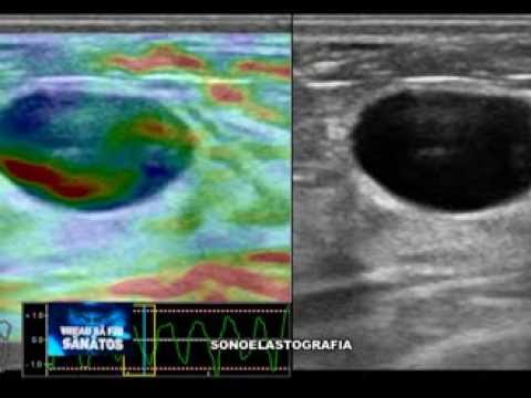 Despre sonoelastografie, la Vreau să fiu sănătos