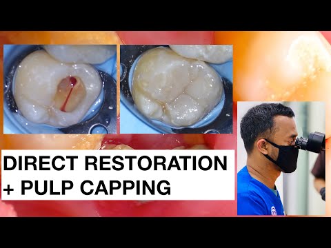 Direct Restoration with Pulp Expose | Pulp Capping