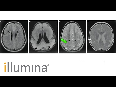 Detecting Somatic Mutations in Neurological Disorders With Targeted NGS