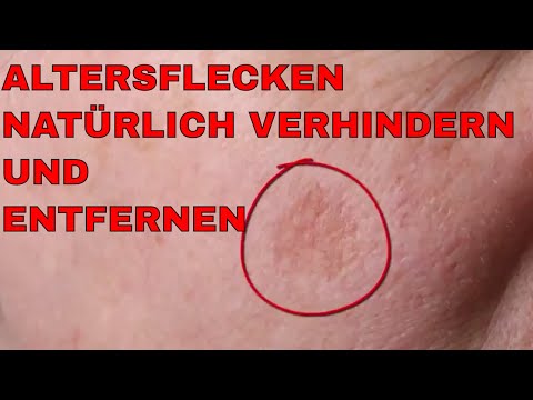 Die Nägel von der Schuppenflechte Als behandelt das Ekzem auf der Fußsohle
