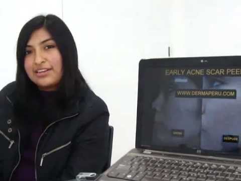 Testimonio Cicatrices de Acne con Isotretinoina – Lisett