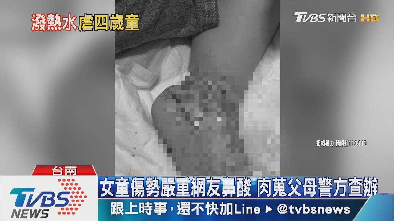 4歲女童雙腳燙傷潰爛 繼父改口坦承潑熱水