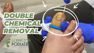 Lurking INFECTION Under INGROWN Nails