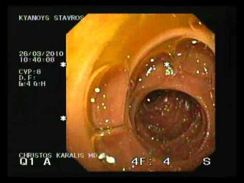 Spiral Enteroscopy, Arteriovenous Malformation (AVM) Laserotherapy