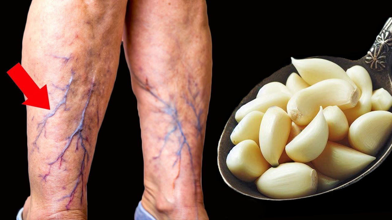 Unbelievable! 🤩 Destroys varicose veins and inflammation naturally (Did you know that?)