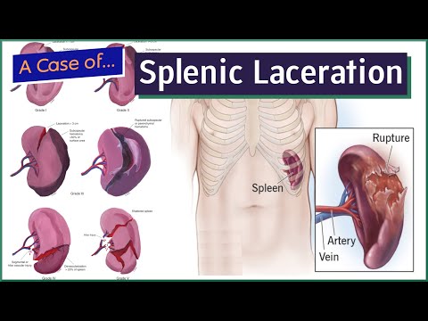 Splenic Laceration