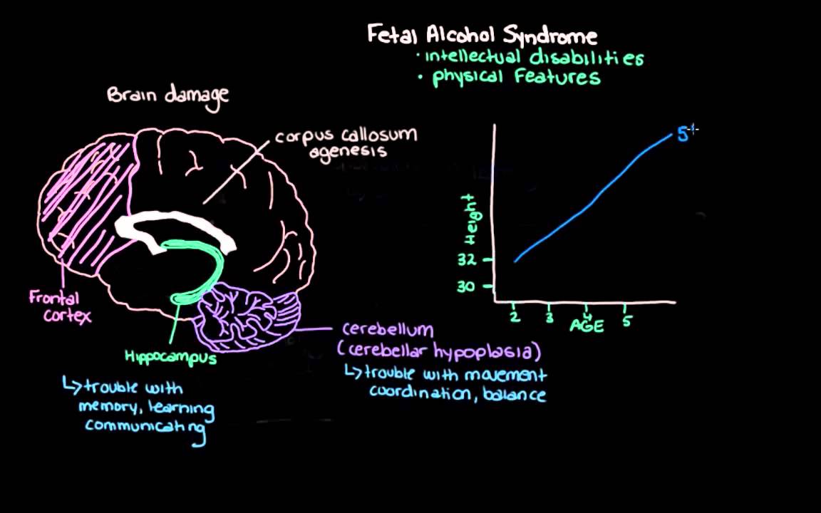 Khan Academy - What is Fetal Alcohol Syndrome?