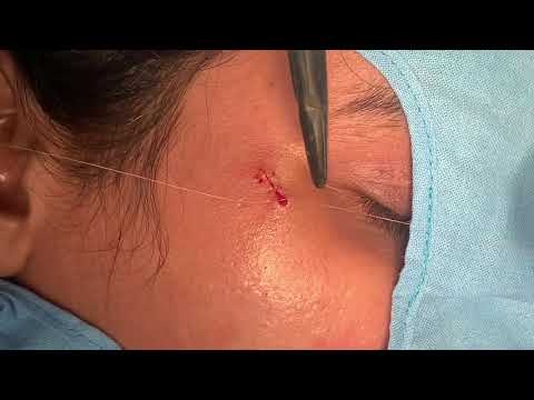 Treatments For Acne Scar