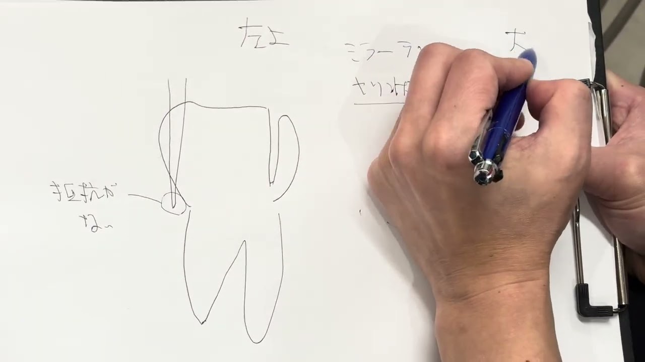 マンツーマンセミナー：左上6番支台歯形成(2/14)スライスしきれなかった場合の原因と対応の仕方解説