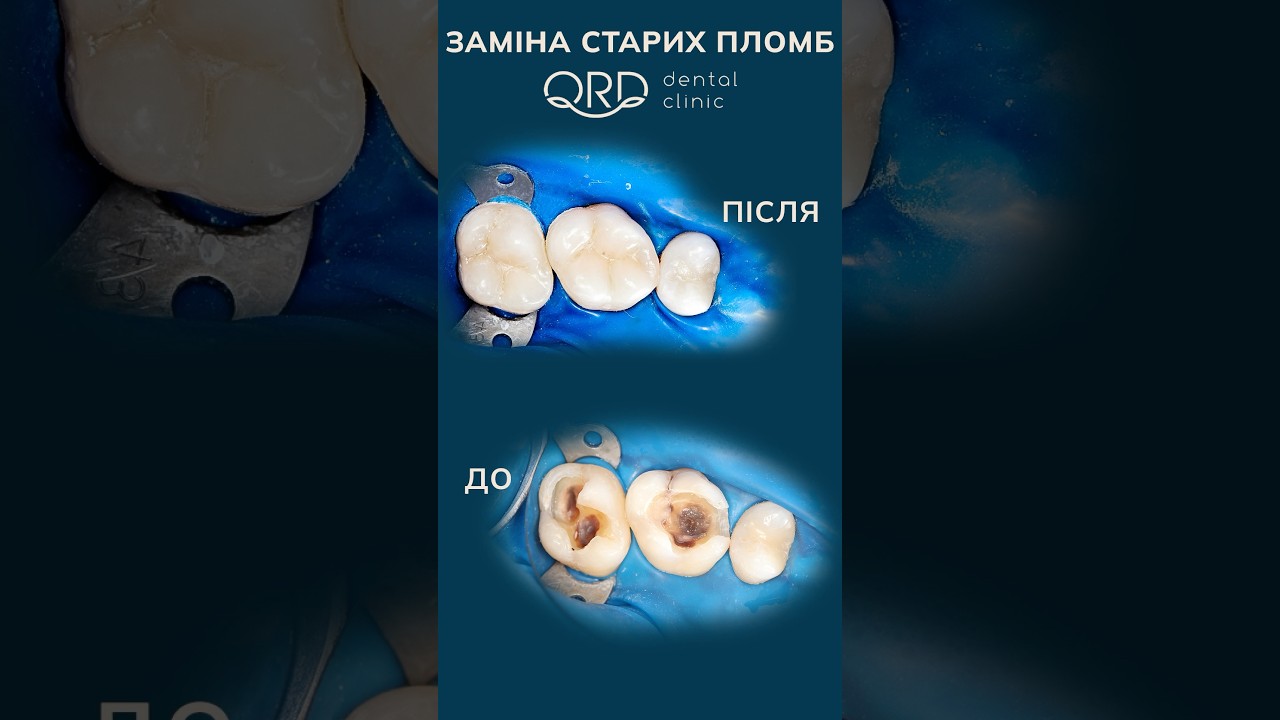 Вторинний карієс