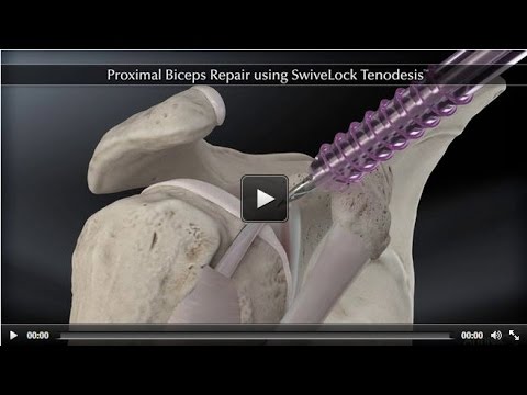 Proximal Biceps Repair using SwiveLock® Tenodesis