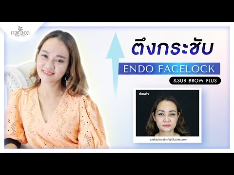 บอกต่อความประทับใจ " ดึงหน้าถาวร Endo-Facelock ที่ นารดาคลินิก "