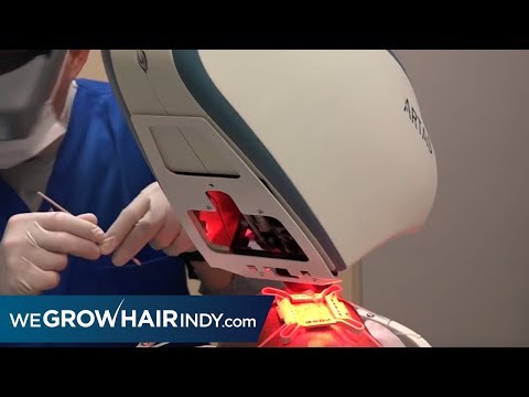 Crown ARTAS Robotic FUE Hair Transplant Procedure
